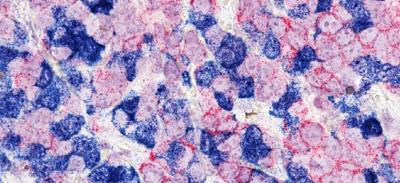 Human breast cancer cells with two different tracers (red and blue) to investigate the interaction of tumor cells.