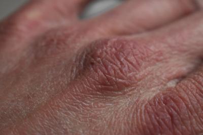 Close up of a hand with dry, cracked skin.