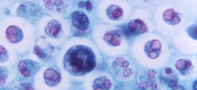 Magnified 1125X, this photomicrograph revealed the presence of a macrophage containing a number of phagocytized red blood cells (RBCs).