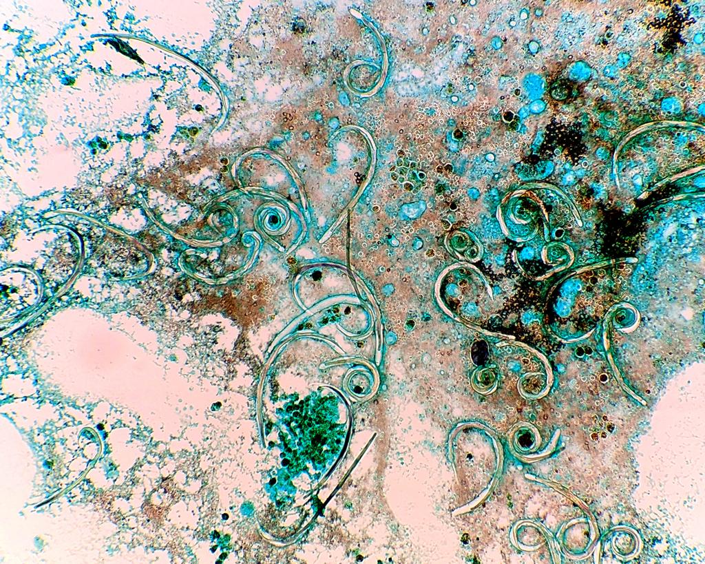 1st place - “Strongyloides Swirls”, Bronchoalveolar lavage with GMS stain