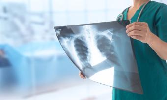 Doctor holding an x ray of a patients lungs.