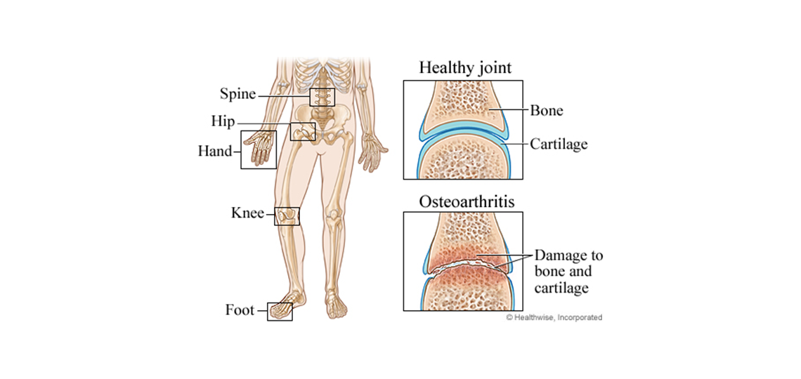 osteoarthritis in joints