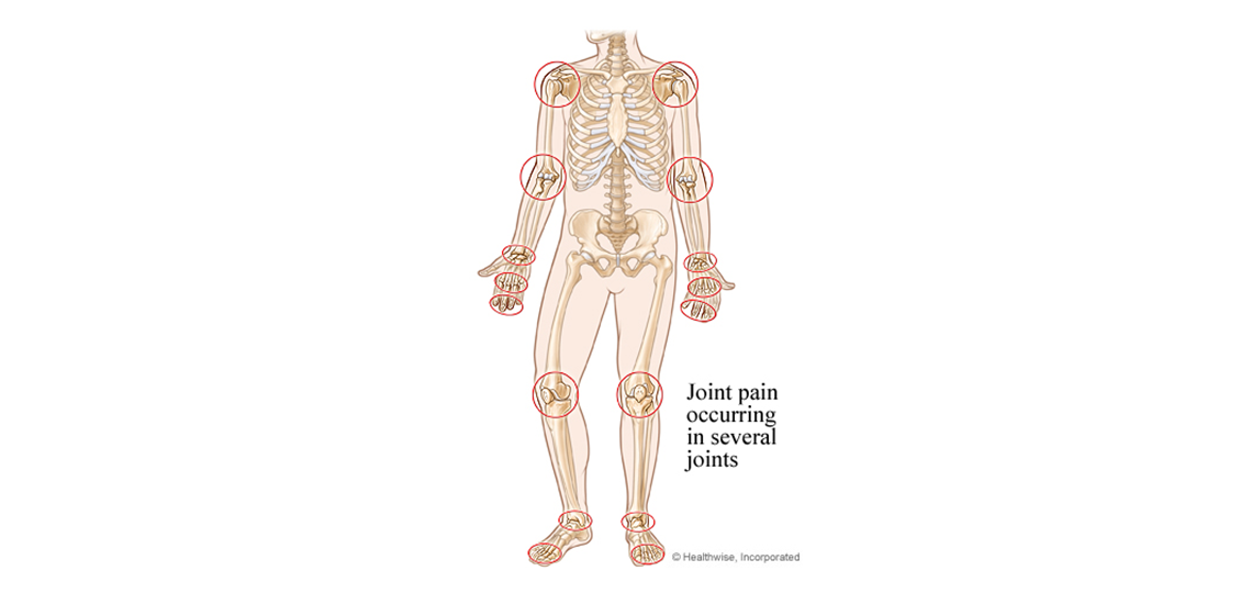 joints affected by rheumatoid arthritis