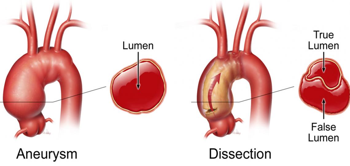 Aortic Dissection by Scott weldon