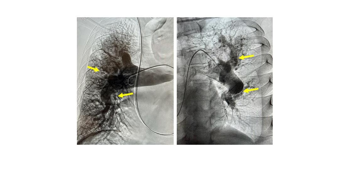 From left: Right pulmonary angiogram showing obstructed blood flow to the right lung (yellow arrows) in a patient with CTEPH. On right: Left pulmonary angiogram showing severely impaired blood flow to the left lung (yellow arrows) in a patient with CTEPH.