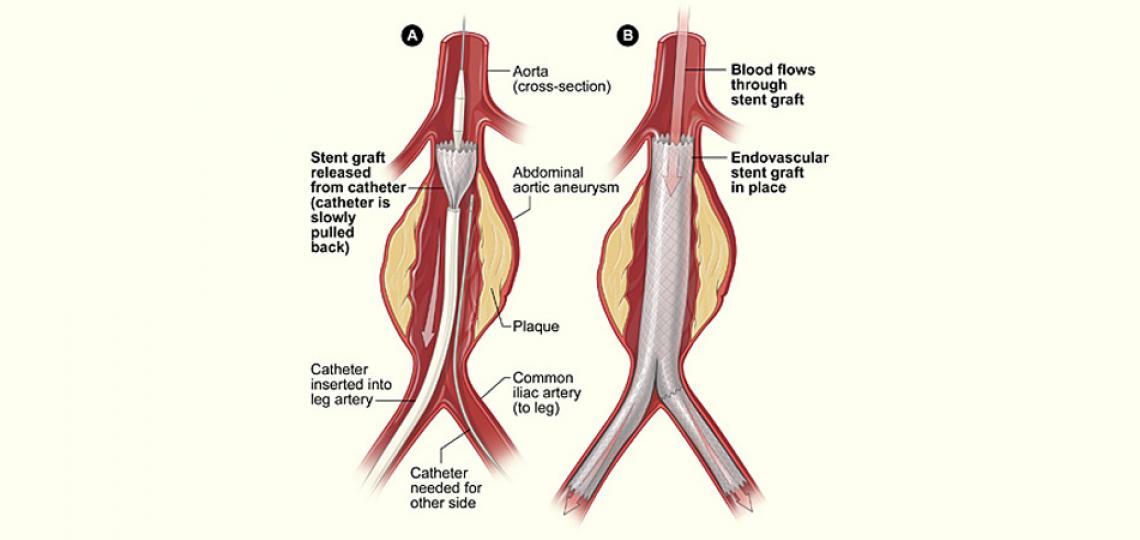 Illustration of a ruptured abdominal aortic aneurysm (AAA)