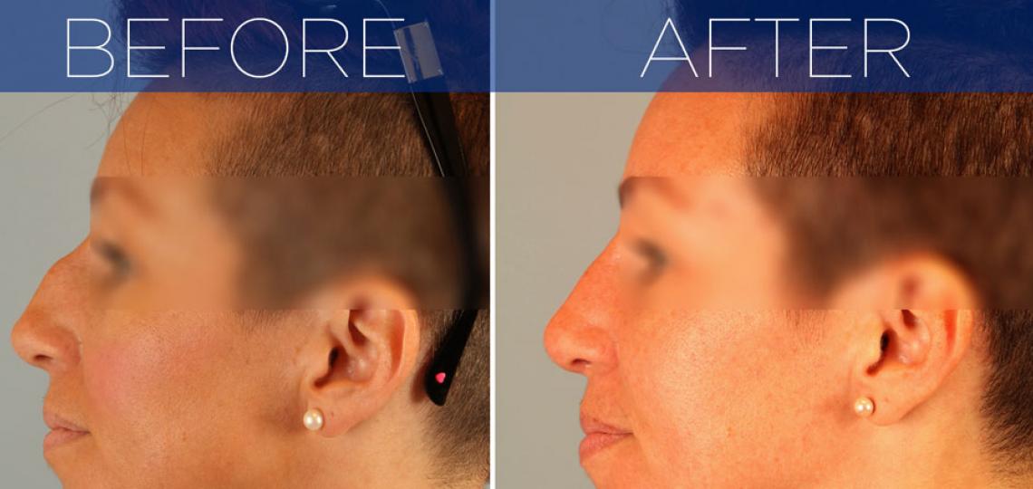 Before and After - Rhinoplasty (Nose Reshaping)