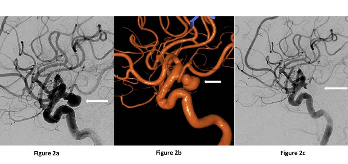 Fgiure 2. Lateral view of the same ruptured left posterior communicating artery aneurysm (arrow) on a cerebral angiogram: before aneurysm treatment (a, b) and after treatment with aneurysm coiling (c).