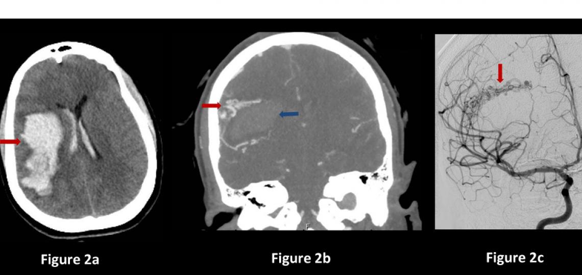 Figure 2. Brain AVM