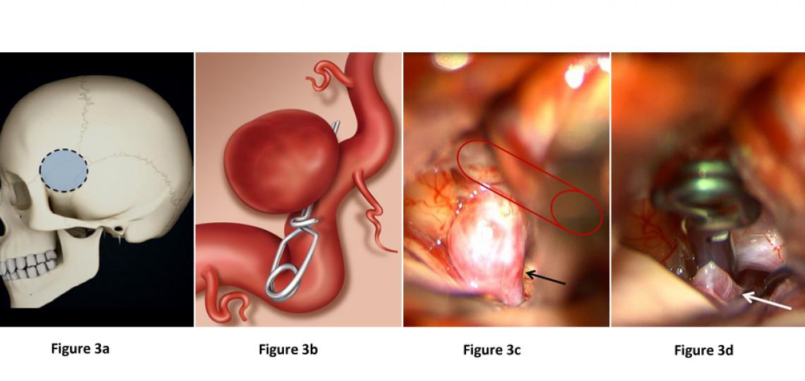 Figure 3. Surgical clipping for brain aneurysm