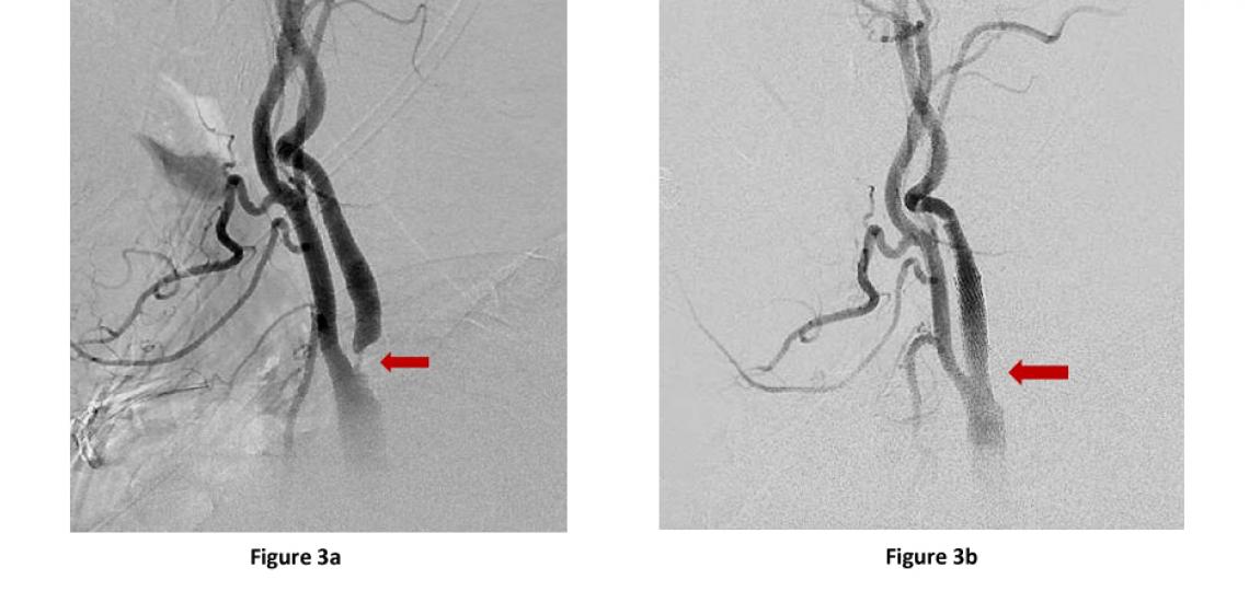 (a) Neck angiogram lateral (side) view of left carotid artery with severe stenosis of internal carotid artery (red arrow) at its origin. (b) Lateral view of same patient after placement of carotid stent showing full re-opening of stenosis (red arrow).