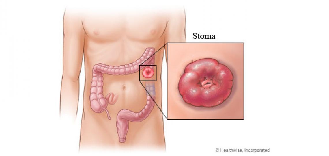 A colostomy