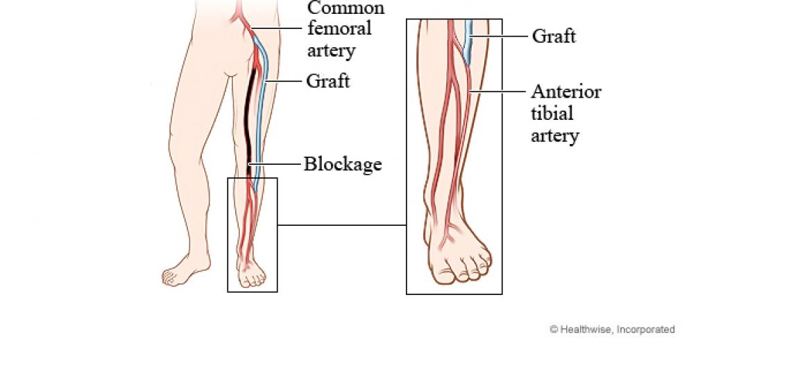 Peripheral artery bypass