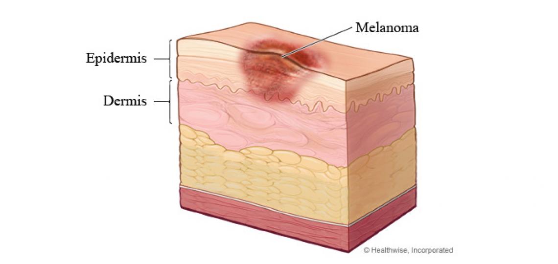 Melanoma - skin layers