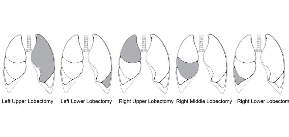 Types of lobectomies, grey indicates resected lobe