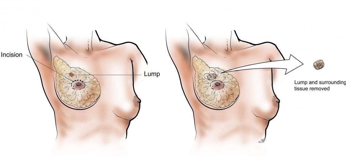 Diagram of Lumpectomy.