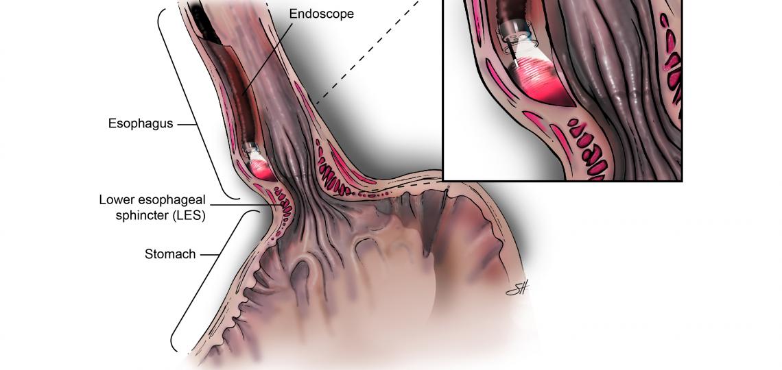 Peroral Endoscopic Myotomy (POEM)
