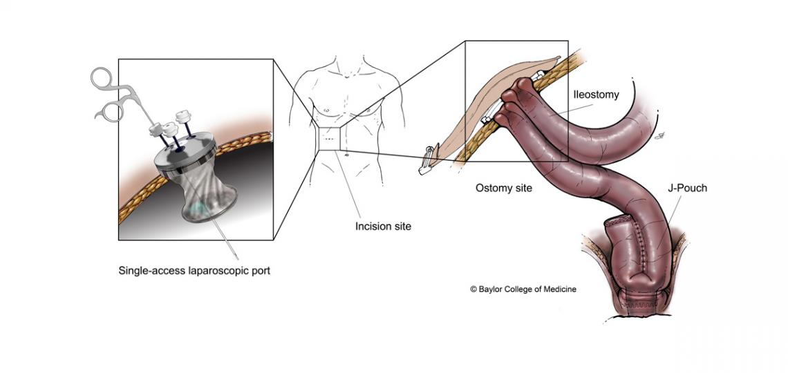 The single-access J-pouch procedure utilizes the same incision site for both the laparoscopic access port and the site of the ileostomy. Illustration by Scott Holmes