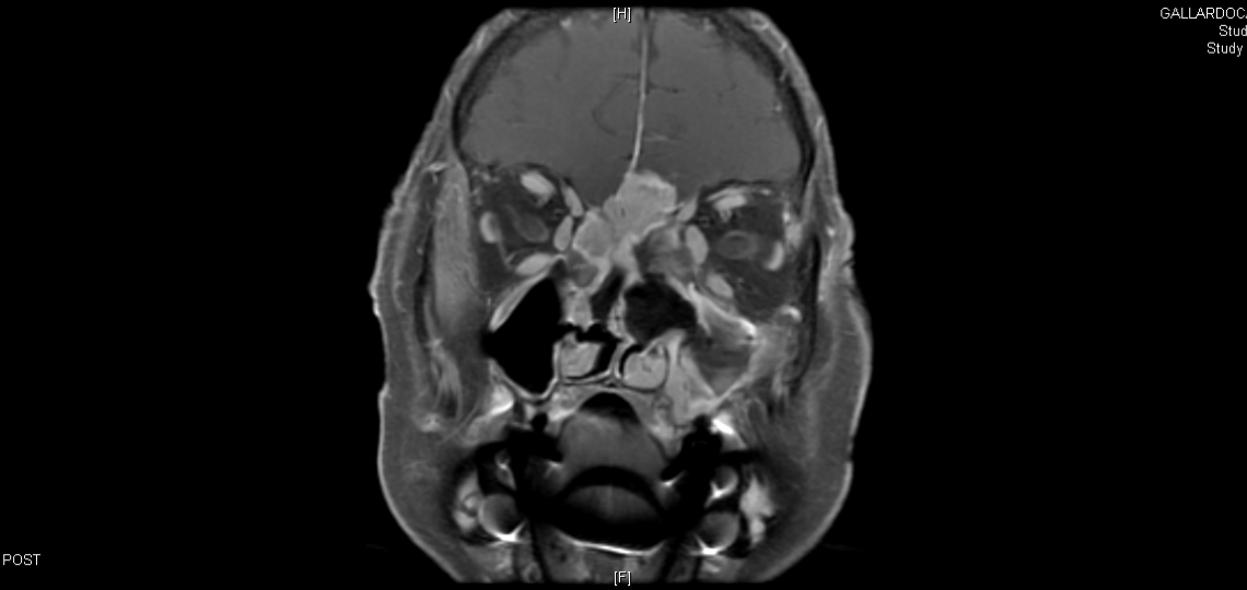 Skull Base Surgery Skull cranial region houston texas medical center experts