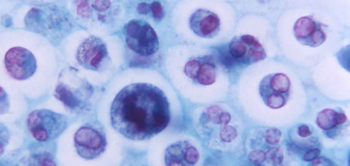 View of a group of cells beneath a microscope Magnified 1125X, this photomicrograph revealed the presence of a macrophage containing a number of phagocytized red blood cells (RBCs).