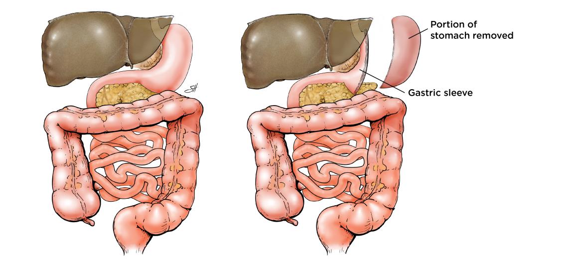 Illustration of gastric sleeve procedure