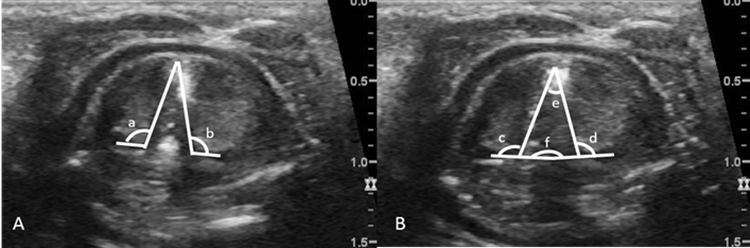 Two ultrasound images of normal true vocal fold movement/position and impaired true vocal fold movement.