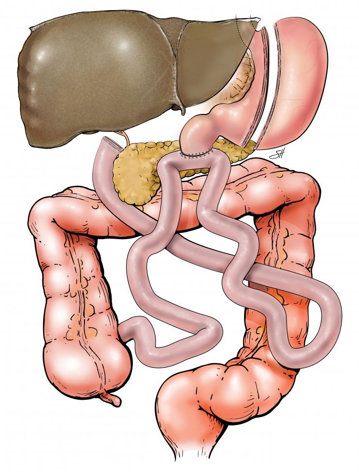 Illustration of the SADI-S procedure