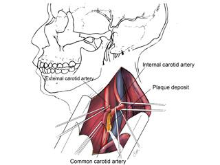 Carotid Endartectomy With Skull