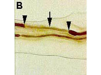 Demyelination of a nerve segment (solid arrow) between the two nodes of Ranvier (arrow heads). This finding is frequently observed in the nerve biopsy of CIDP.