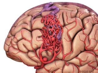 Figure 1. A brain arteriovenous malformation (AVM) is an abnormal tangle of unusually formed blood vessels in the brain.