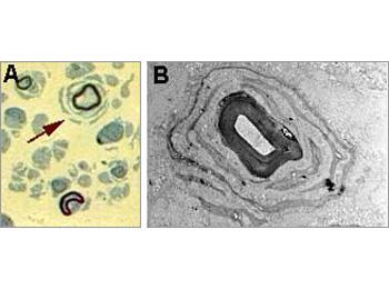 Onion bulb formation observed in semi-thin sections (A) and by electron microscopy (B).