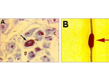Hereditary neuropathy with liability to pressure palsies. (A) Note nerve fibers with "thickened" myelin sheath as is seen in semi-thin sections (arrow). In a single teased nerve fiber preparation (B), the "thickened" area appears as sausage-like structure