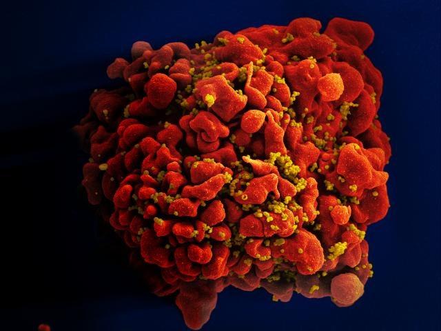 Scanning electron micrograph of an HIV-infected H9 T cell.