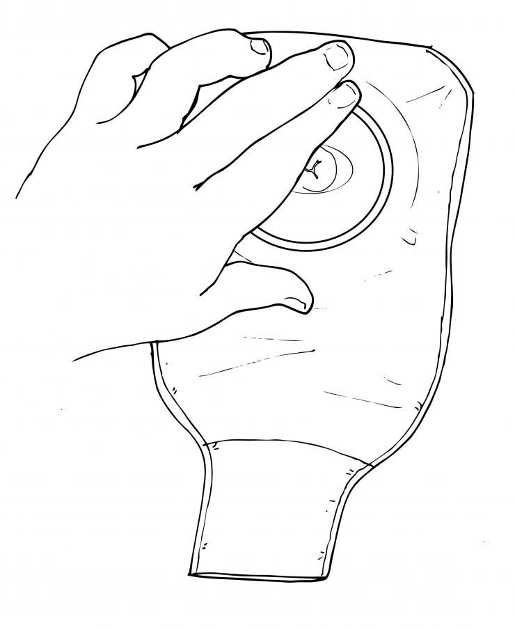 Ostomy bag placement. Illustration by Scott Holmes