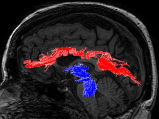 Sagittal MRI image