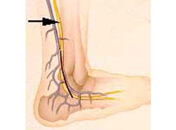 Anatomical location of a sural nerve.