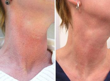 Above are before (left side) and after (right side) photographs of a patient treated at Baylor Dermatology for poikiloderma (redness on the neck) with two IPL treatments.