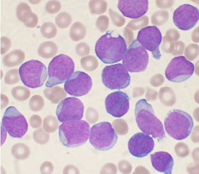 Acute_leukemia-ALL-VashiDonsk-Wikimedia-Commons