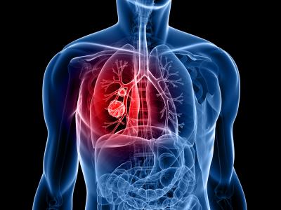 A graphical illustration of lung cancer.