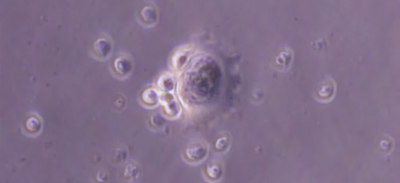 Photomicrograph of HER2 targeting T cells seeking, engaging and killing human medulloblastoma cells.