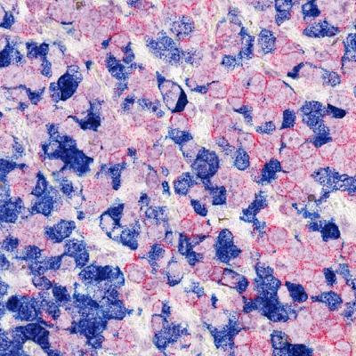 Breast Cancer Cells