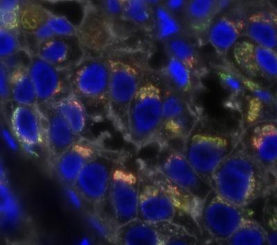 Wide field fluorescence microscopy of human triple-negative breast cancer