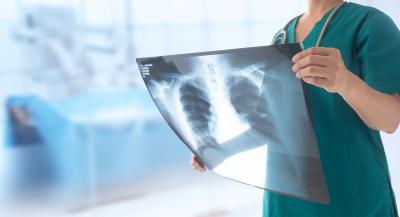 Doctor holding an x ray of a patients lungs.