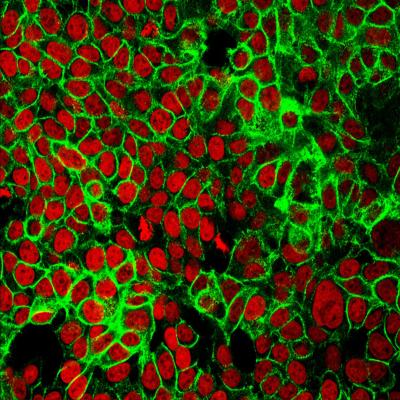 Human colon cancer cells with the cell nuclei stained red.