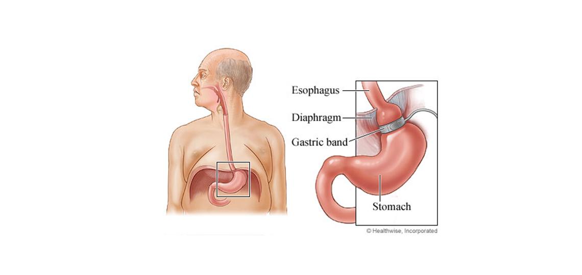 Lap band procedure