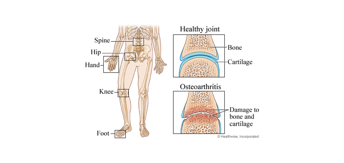 Osteoarthritis