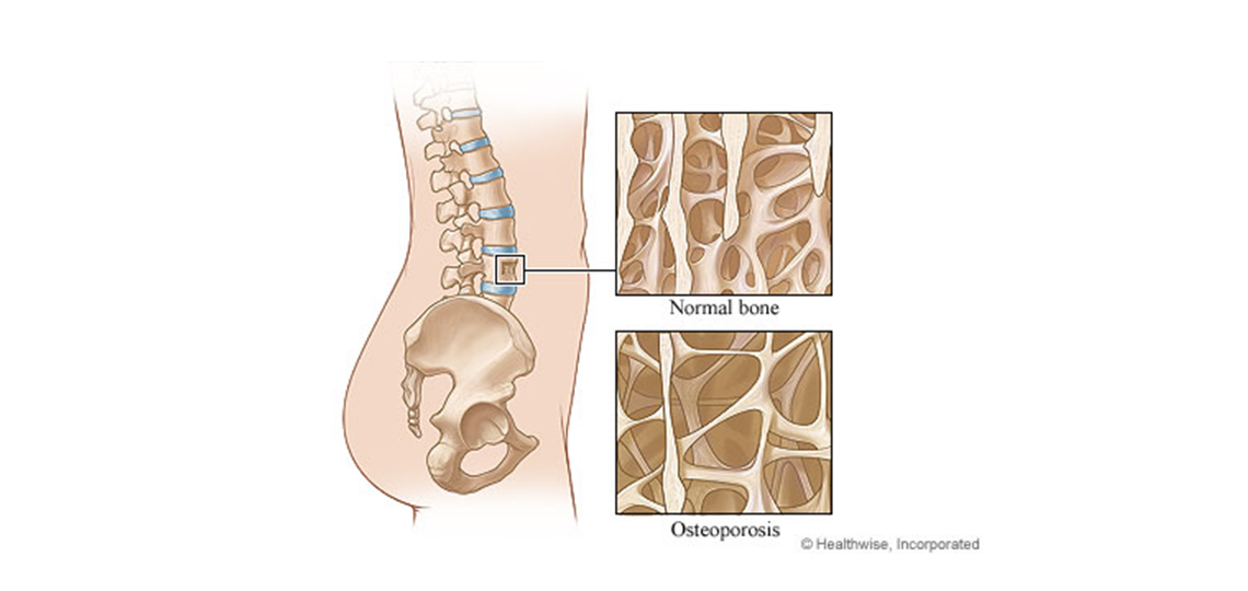 Healthy Bone Versus Bone Weakened by Osteoporosis