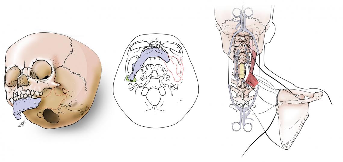Craniofacial Microsomia and Spino-Plastic Reconstruction illustrations