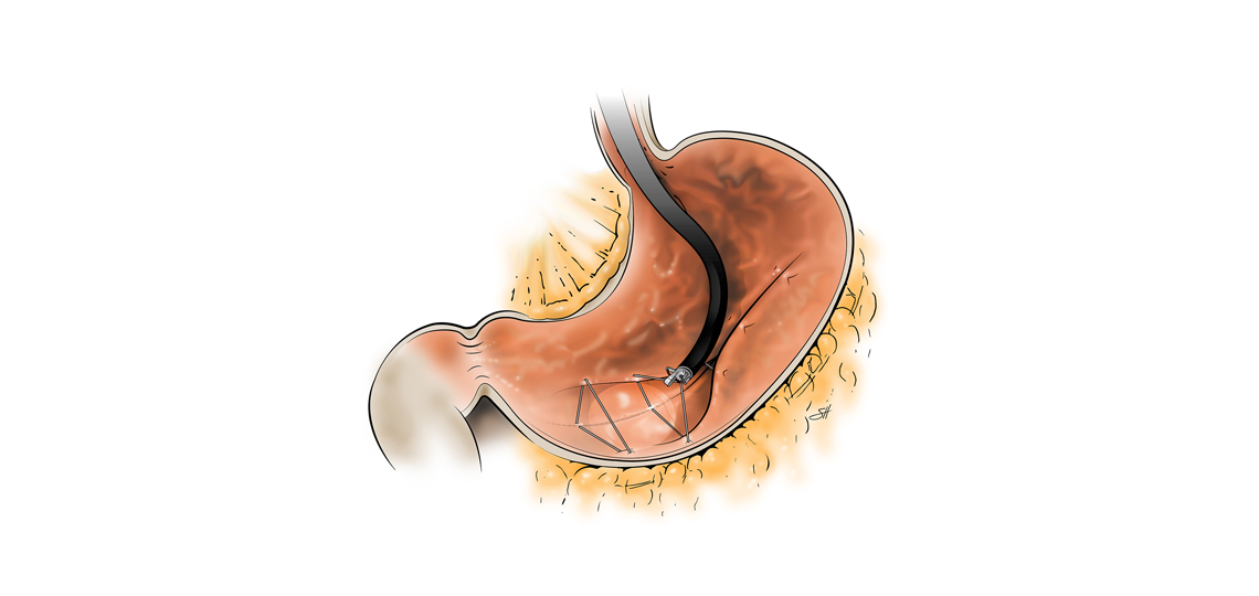Endoscopic sleeve gastroplasty illustration