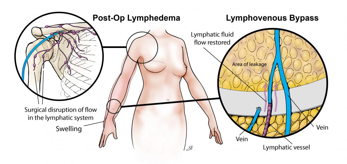 Lymphovenous bypass surgery